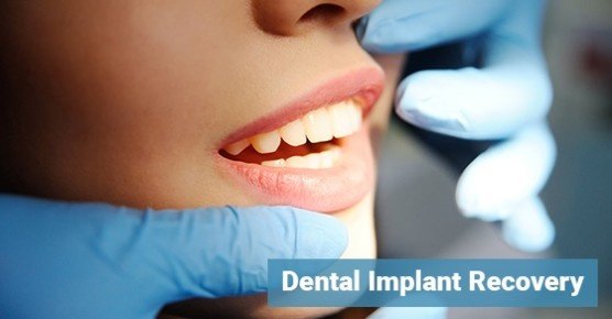 dental implant aftercare instructions